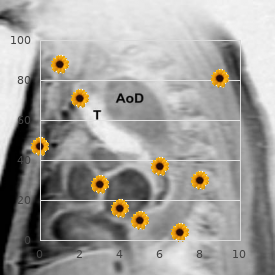 Oculomotor nerve palsy