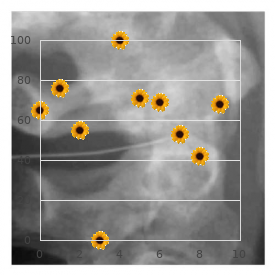 Chromosome 7, trisomy 7p