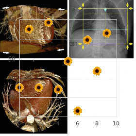 Hypercementosis