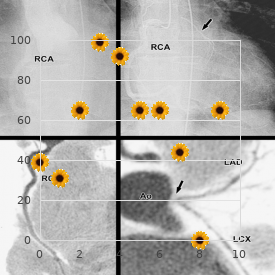 Ceramide trihexosidosis