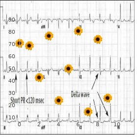 Familial hyperlipoproteinemia