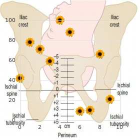 Dental caries