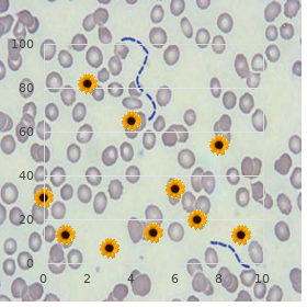 Immune thrombocytopenia