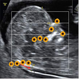 Ophthalmomandibulomelic dysplasia