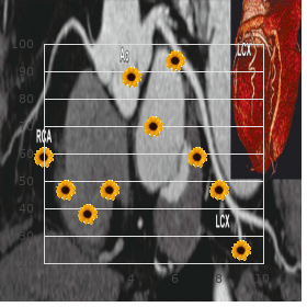 Adenoma