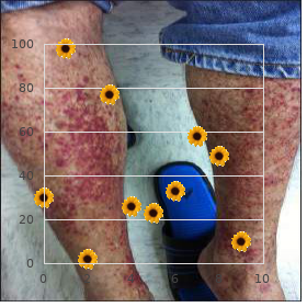 Gonadal dysgenesis XY type associated anomalies