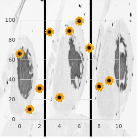 Facial dysmorphism macrocephaly myopia Dandy Walker type