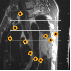 Morgellons disease