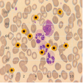 Microcephaly glomerulonephritis Marfanoid habitus