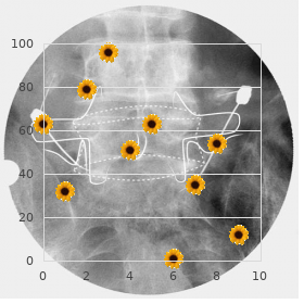 Delayed membranous cranial ossification