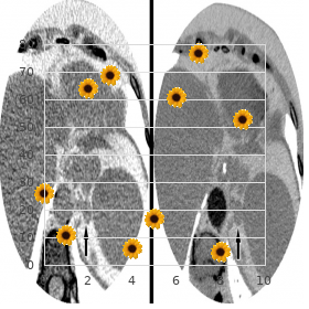 Retinal telangiectasia hypogammaglobulinemia